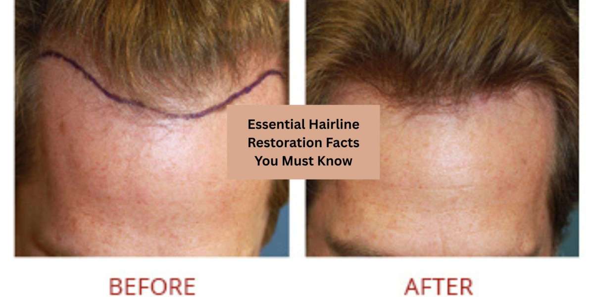 Essential Hairline Restoration Facts You Must Know
